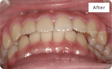 キレイライン矯正の後
