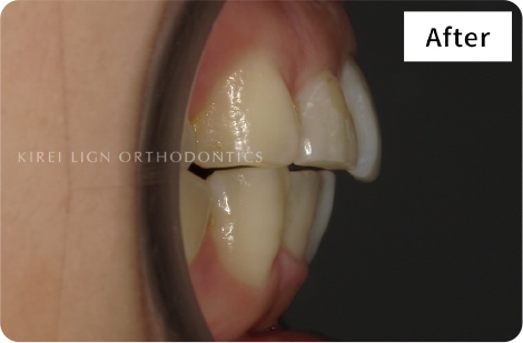 キレイライン矯正の後