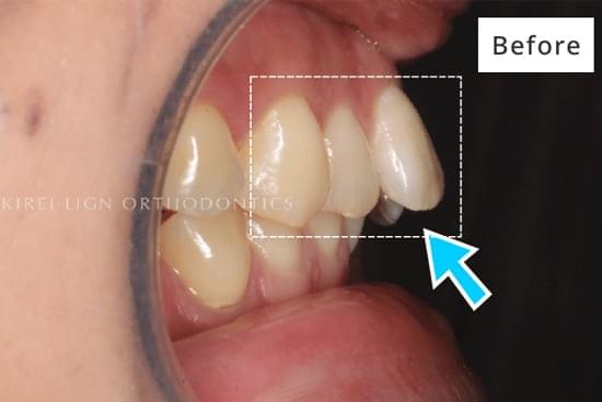 キレイライン矯正の前
