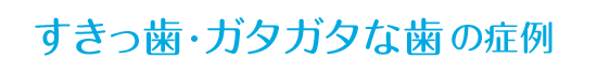 すきっ歯・ガタガタな歯の症例
