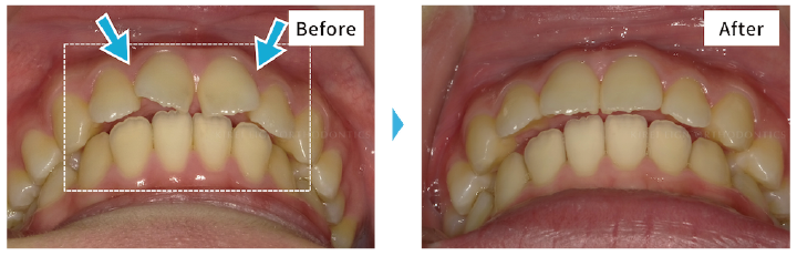出っ歯、すきっ歯のビフォーアフター