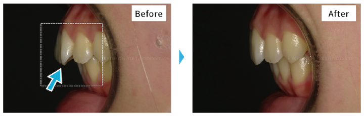 出っ歯、すきっ歯のビフォーアフター