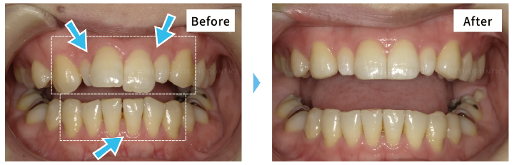 ガタガタな歯のビフォーアフター