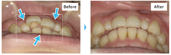 ガタガタな歯のビフォーアフター