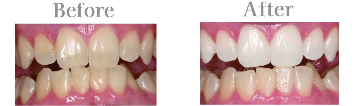 ホワイトニングのビフォーアフター