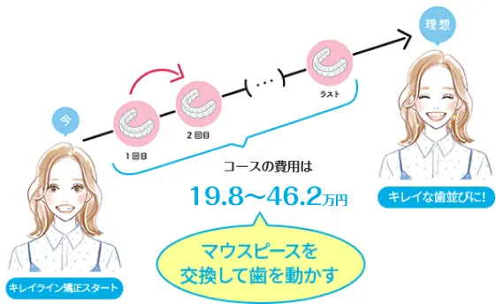 キレイライン矯正は、マウスピースを交換して、あなたの歯を少しずつ動かしてい治療法です。