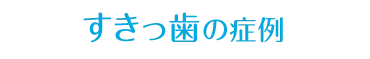 すきっ歯の症例