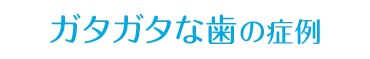 すきっ歯・ガタガタな歯の症例