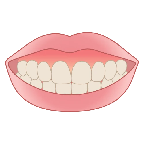 ガミースマイルのイラスト