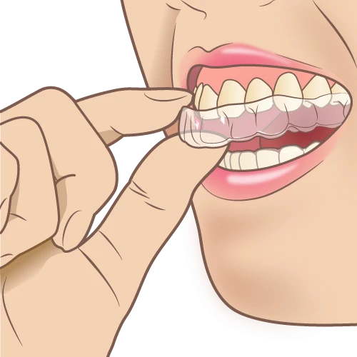 透明なマウスピース矯正装置のイラスト