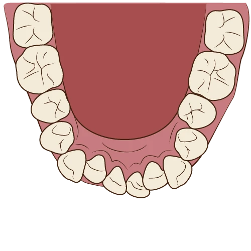 叢生(ガタガタの歯並び)のイラスト