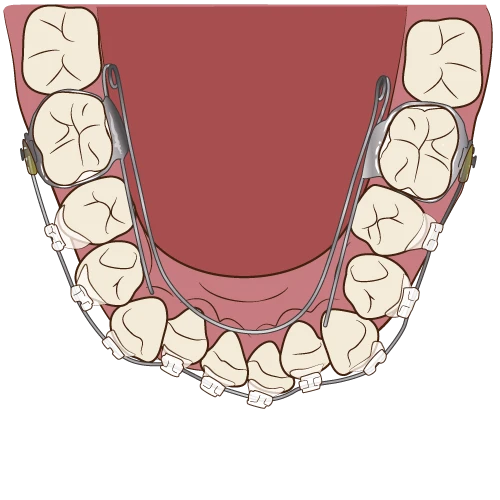 ワイヤー矯正装置のイラスト