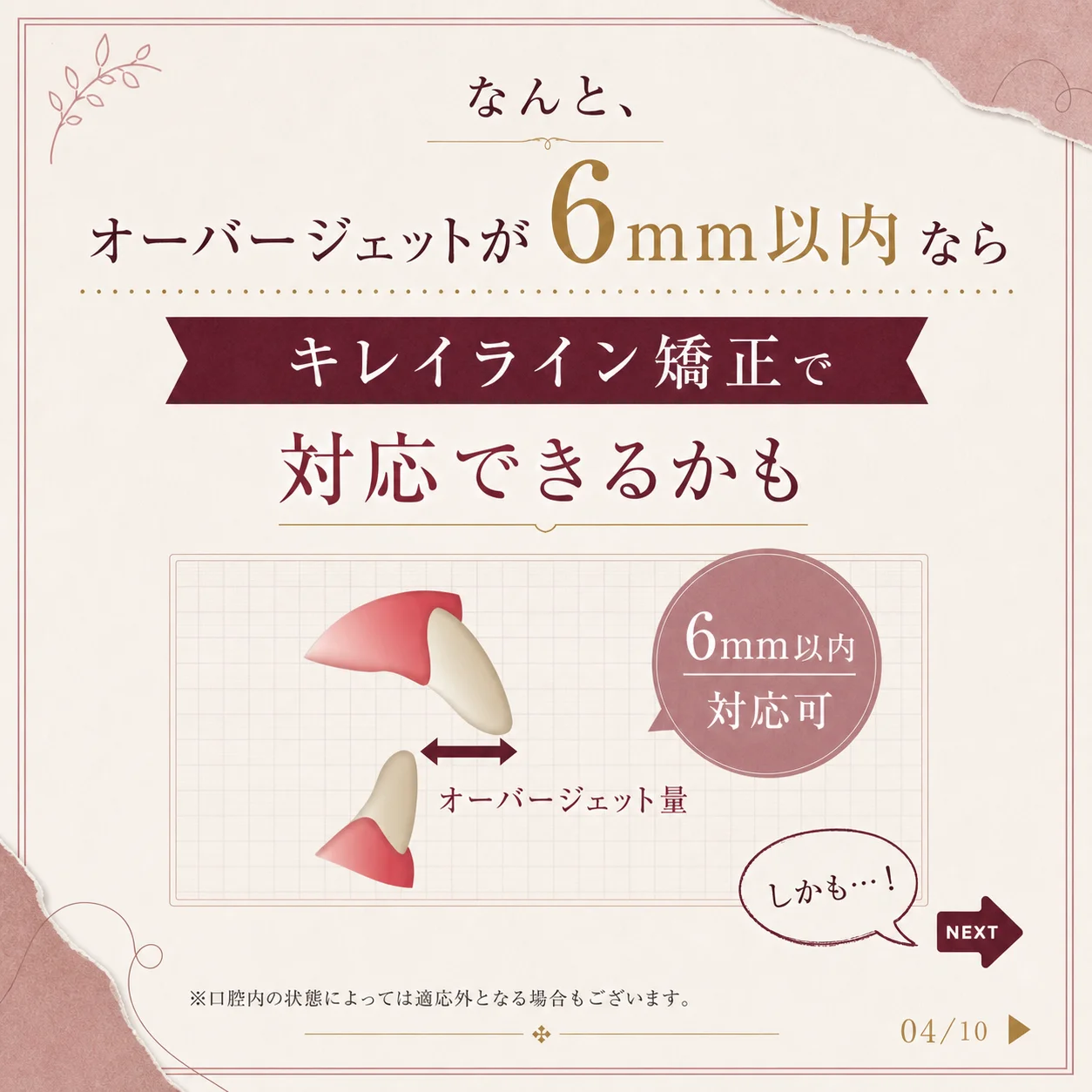 キレイライン矯正の症例 4