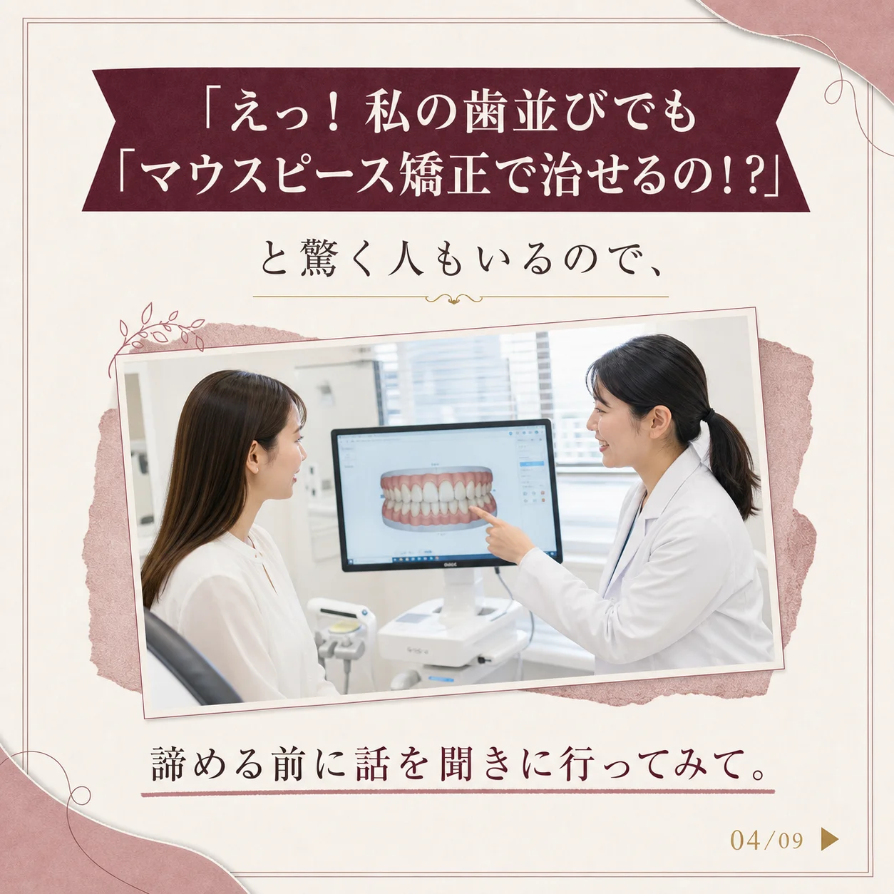 マウスピース矯正の基礎知識 4