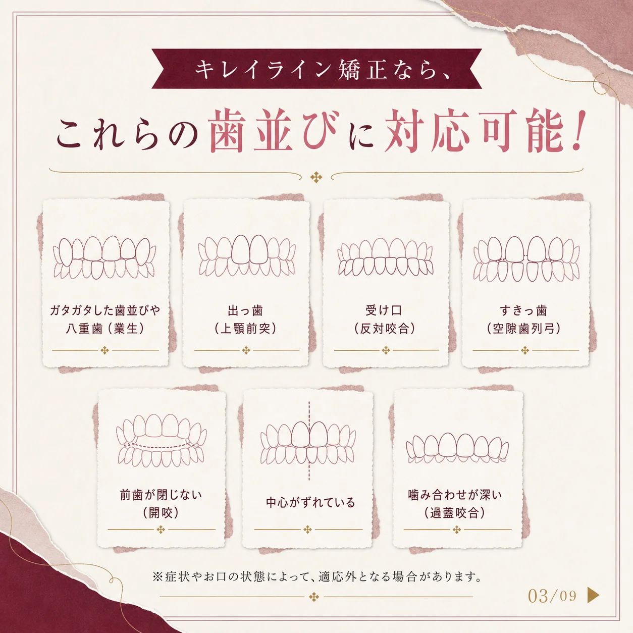 マウスピース矯正の基礎知識 3