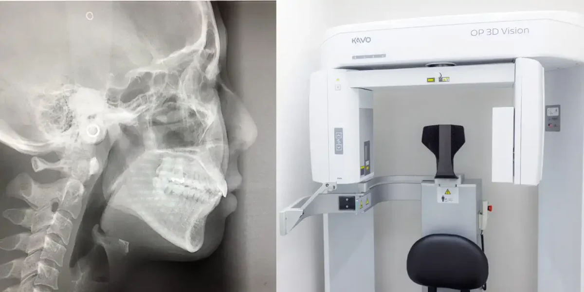 歯科用オープン3DCT