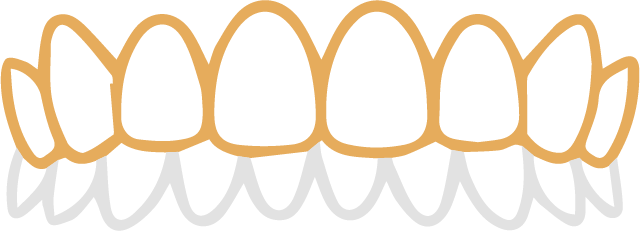 深い噛み合わせの歯並び