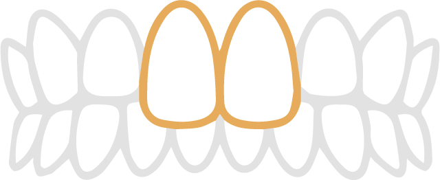 出っ歯の歯並び