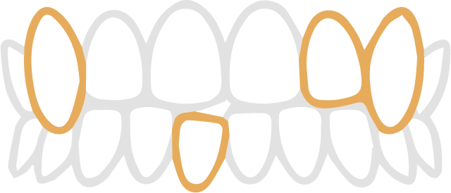 ガタガタ・八重歯の歯並び