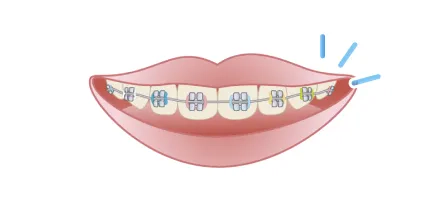 歯並びが気になる