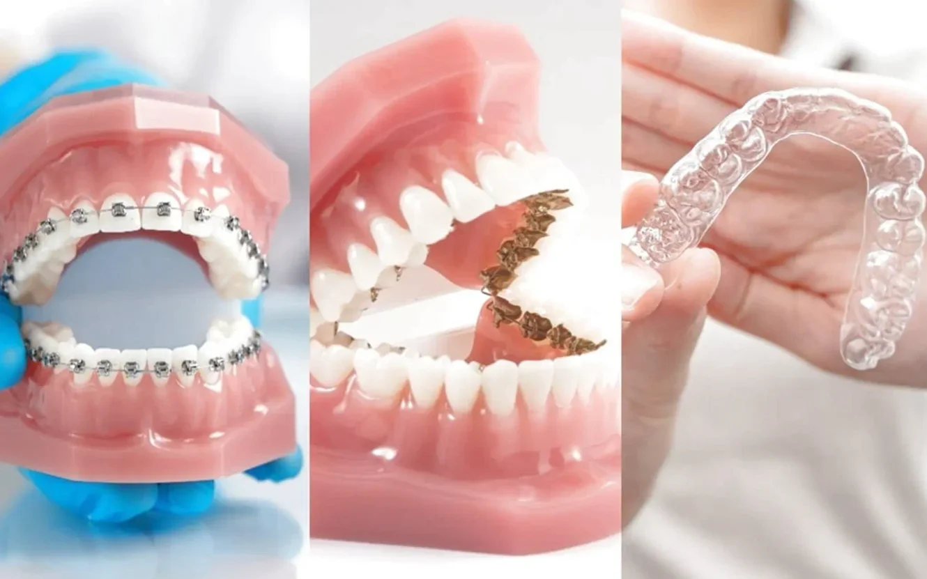 インビザラインとキレイライン矯正の画像