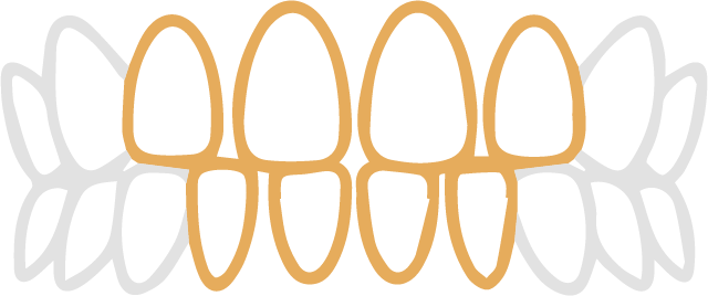 すきっ歯の歯並び