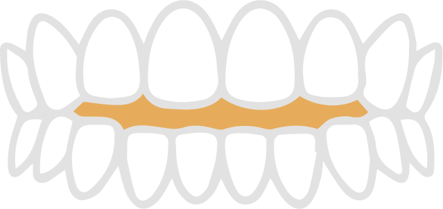 前歯が閉じない歯並び