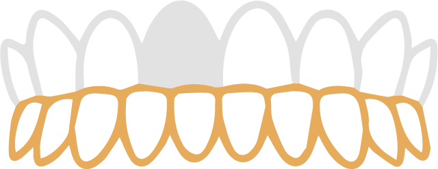 受け口の歯並び