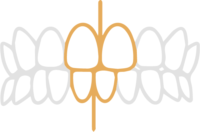 歯の中心のずれ