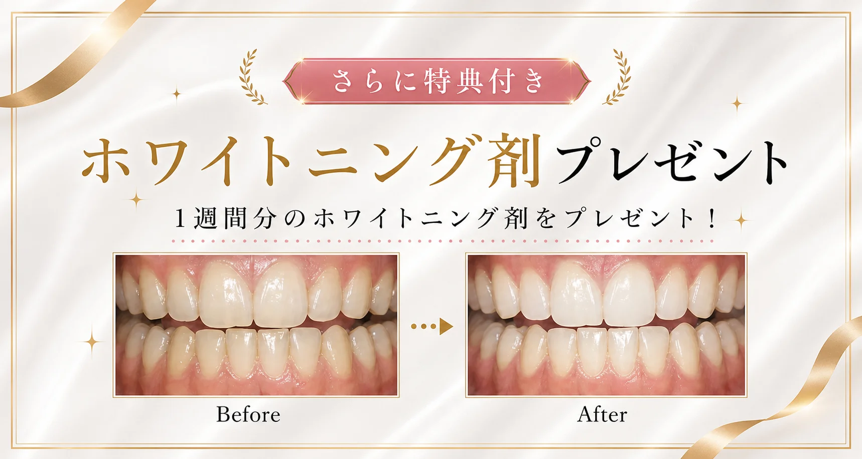 さらに特典付き。1週間分のホワイトニング剤をプレゼント！