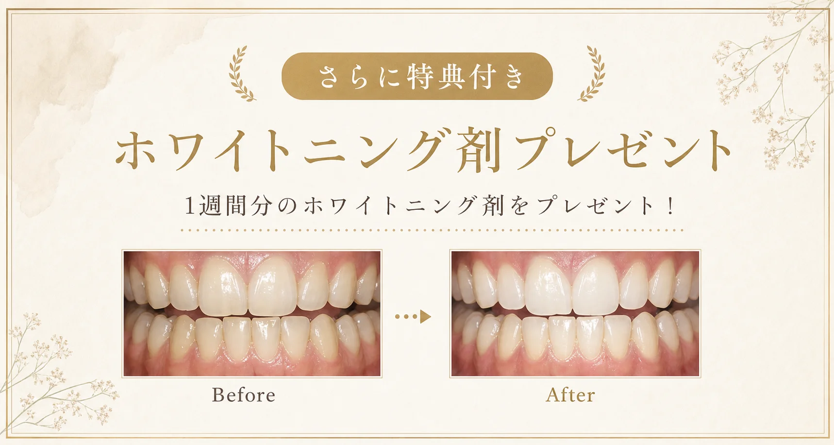さらに特典付き。1週間分のホワイトニング剤をプレゼント！