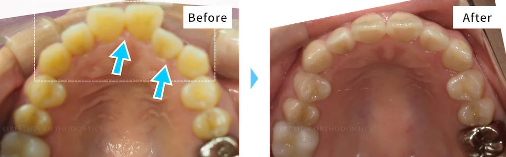 症例No.18013278（叢生・上顎前突）の治療前後の比較 3