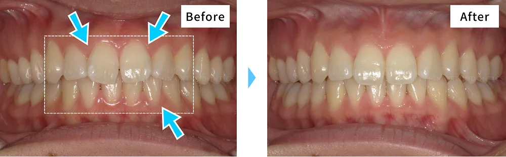 症例No.23043958（叢生）の治療前後の比較 1