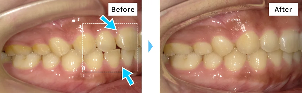 症例No.36053935（空隙歯列）の治療前後の比較 3