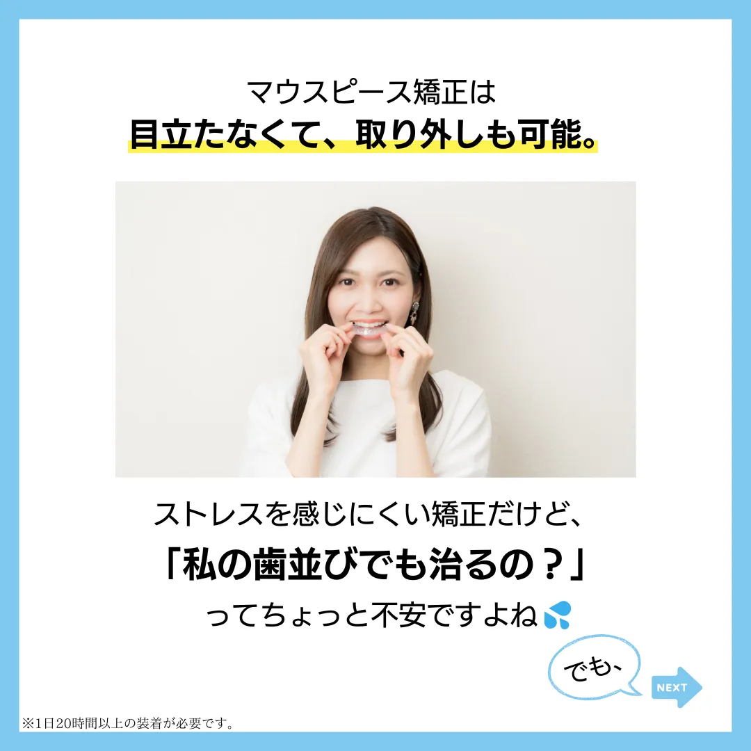 マウスピース矯正を検討中の人にこれだけは知ってほしい2
