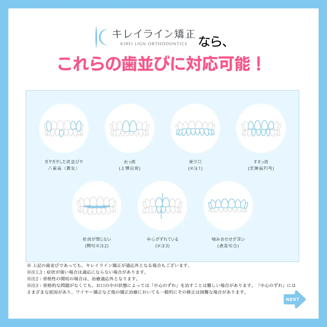 マウスピース矯正を検討中の人にこれだけは知ってほしい3