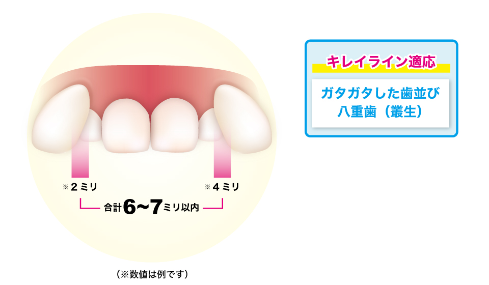 私の八重歯 叢生 でもキレイラインで矯正できる よくある質問と回答 キレイライン矯正