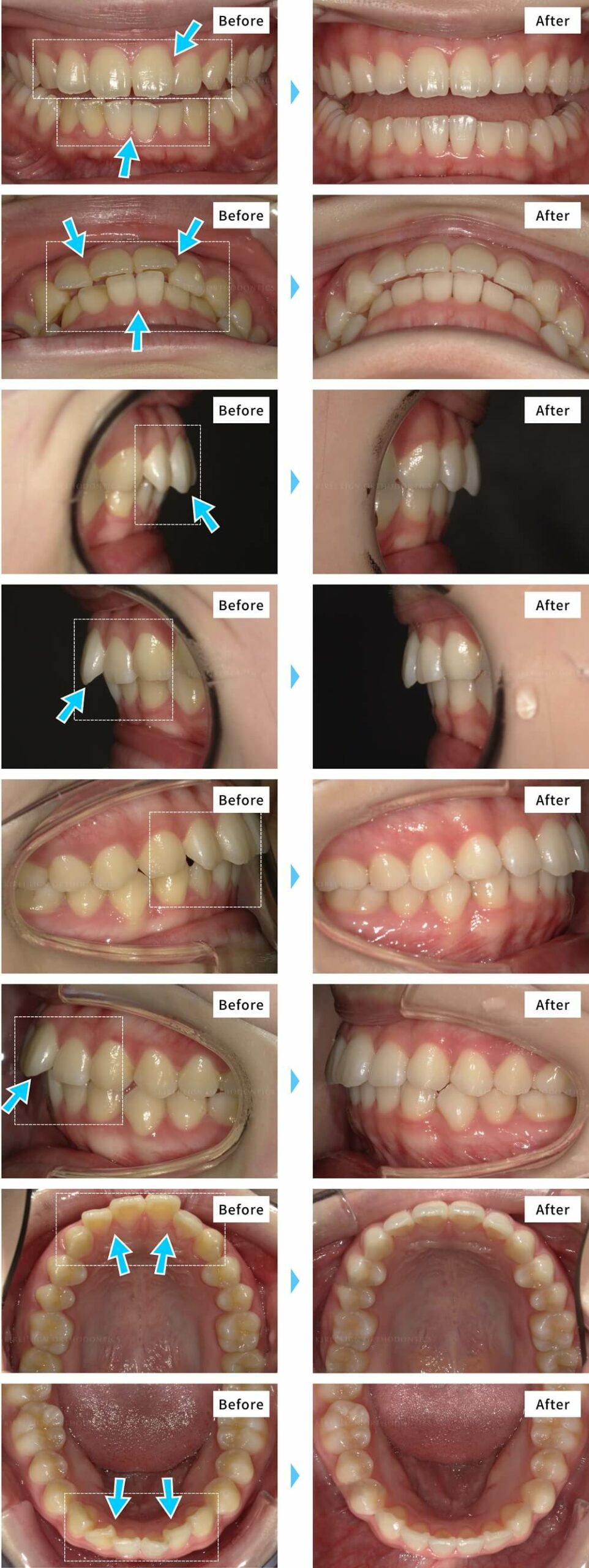 出っ歯・ガタガタの歯並び（叢生）の症例（マウスピース矯正キレイラインを4回治療）