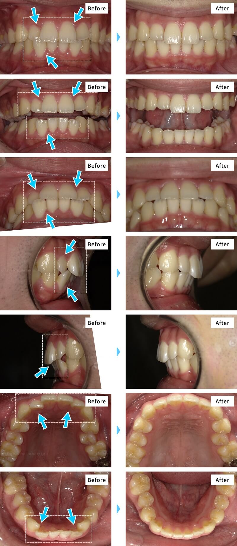 私の八重歯 叢生 でもキレイラインで矯正できる よくある質問と回答 キレイライン矯正 公式 2万円から始められるマウスピース歯科矯正