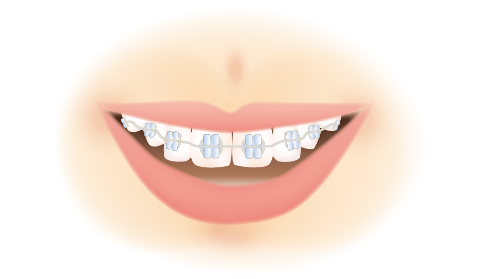 中学生 高校生の歯科矯正 早くから始めた方が良い理由やおすすめの矯正方法 キレイライン矯正