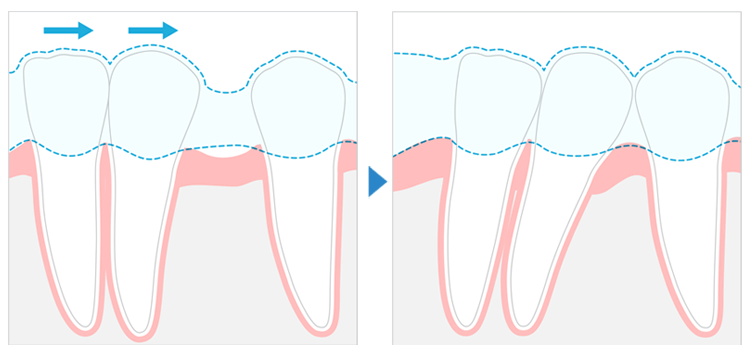 マウスピース矯正 のすべて 目立たない歯科矯正とは 他の矯正との違いや費用 期間 キレイライン矯正