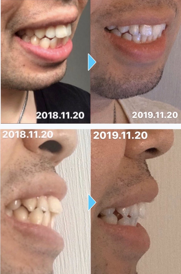 初めての方へ 2万円からのキレイライン矯正って何 特徴と実際の効果をチェック 高田馬場駅前矯正歯科