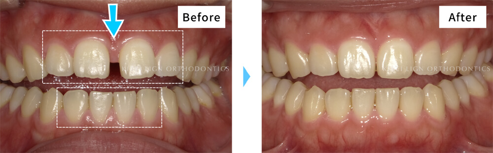 すきっ歯はキレイライン矯正で治る 隙間がある歯並び 空隙歯列 が改善された症例まとめ キレイライン矯正