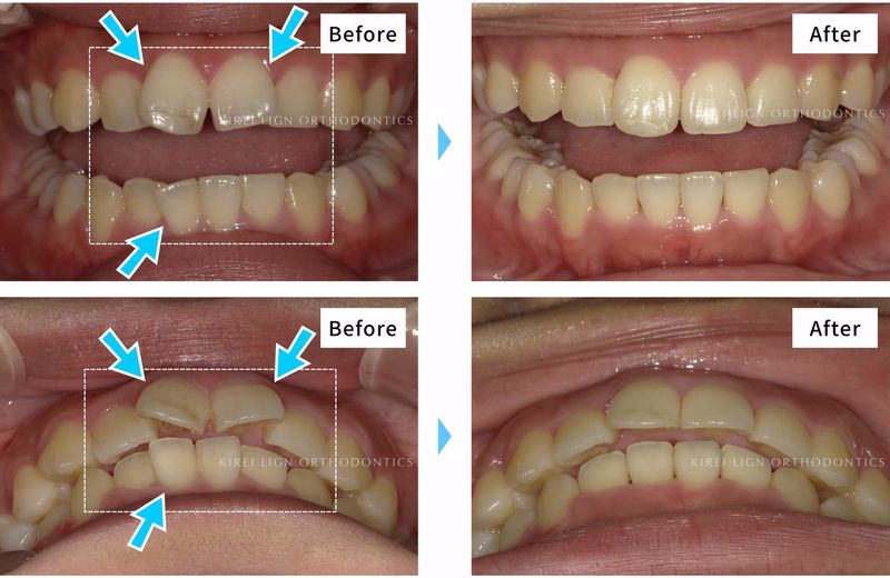 マウスピース矯正 のすべて 目立たない歯科矯正とは 他の矯正との違いや費用 期間 キレイライン矯正