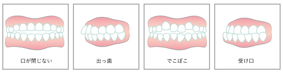 子供の歯並びが悪い 歯列不正の原因や改善方法 キレイライン矯正