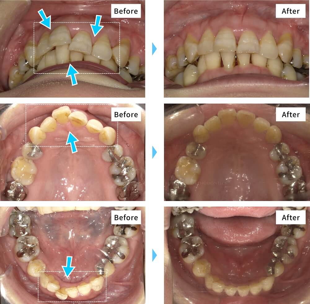 矯正治療は何歳までできる 10代から40代 50代までの症例写真も公開 キレイライン矯正