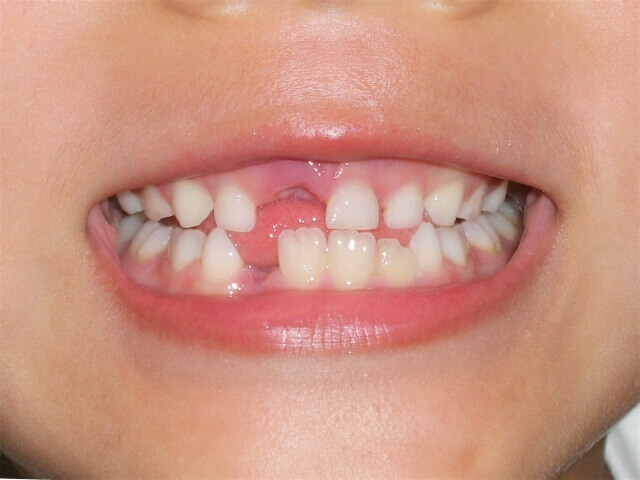 子どもの歯並びに影響するお口の悪い癖って 舌癖の改善や口腔筋のトレーニング方法 キレイライン矯正