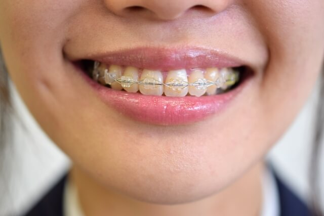 中学生 高校生の歯科矯正 早くから始めた方が良い理由やおすすめの矯正方法 キレイライン矯正