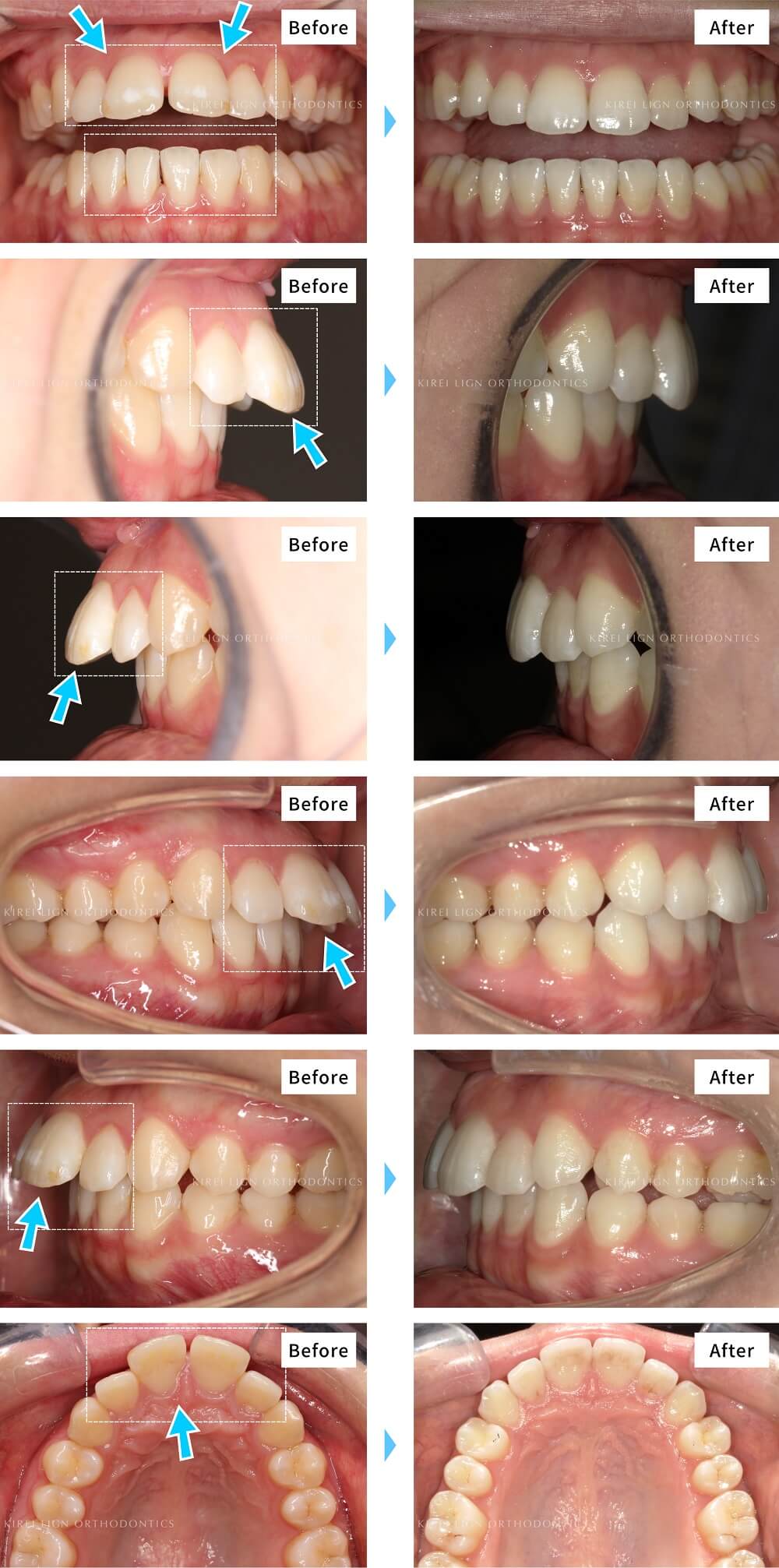 歯列矯正の費用 約10万円 35万円 税別 でどのくらい歯並びがきれいになる キレイラインの症例写真で検証 キレイライン矯正
