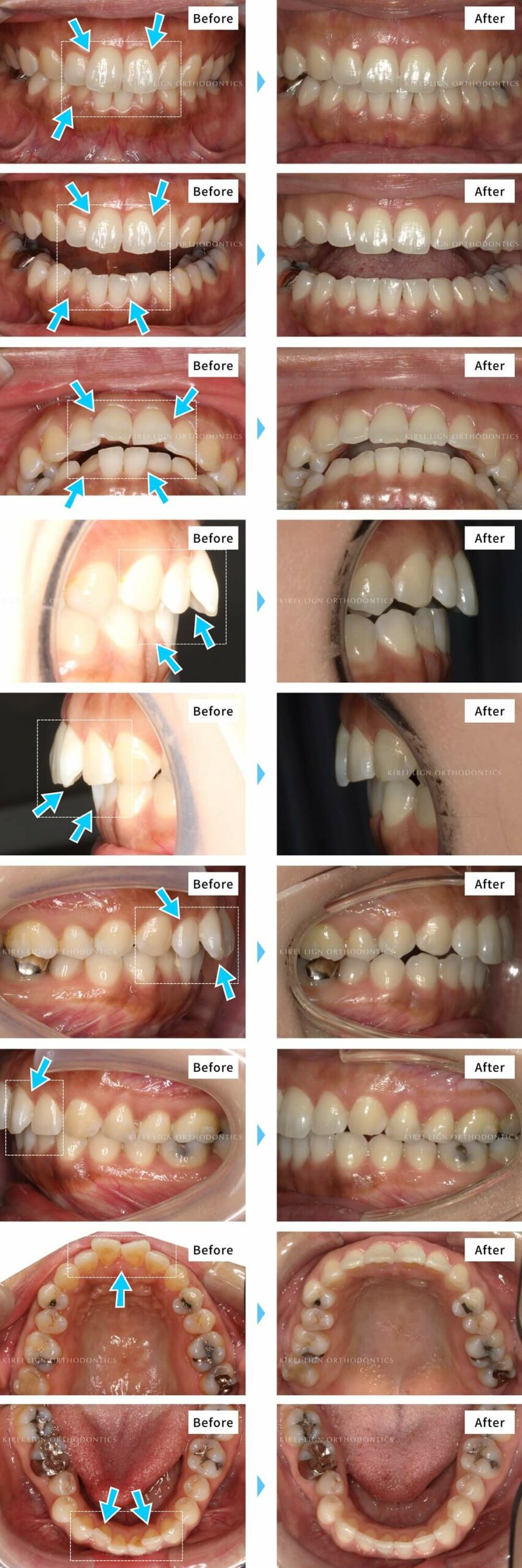 矯正治療は何歳までできる 10代から40代 50代までの症例写真も公開 キレイライン矯正